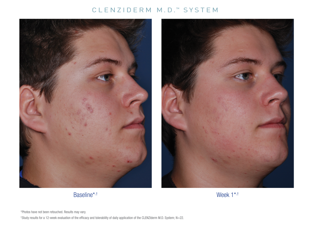 OBAGI CLENZIderm M.D. Therapeutic Lotion 47ml