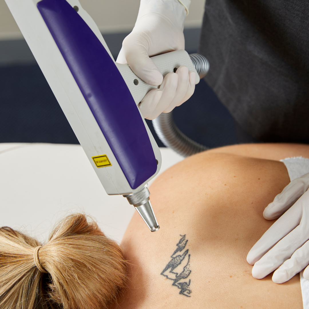 Extended Warranty UltraLASE