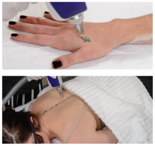 Handpiece - Laser Tattoo Removal (F6)